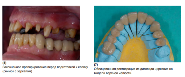 BeautiCem SA Auto-mixing, цемент самопротравливающий, самоадгезивный двойного отверждения (Ivory) SHOFU,Япония