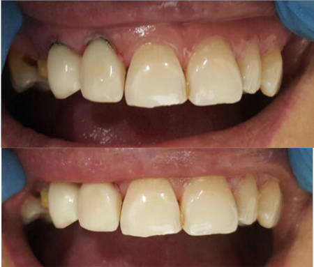 Camouflage (8) Megadenta Dentalprodukte, Германия